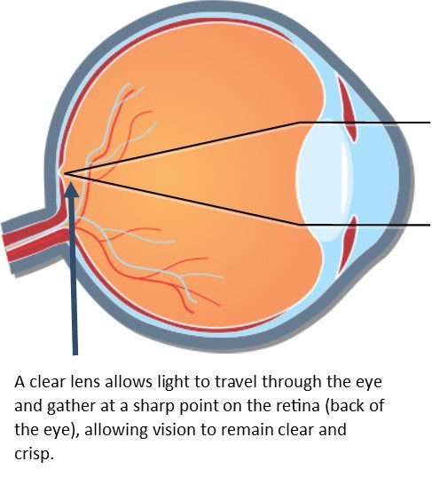 Cataract Diagram #1