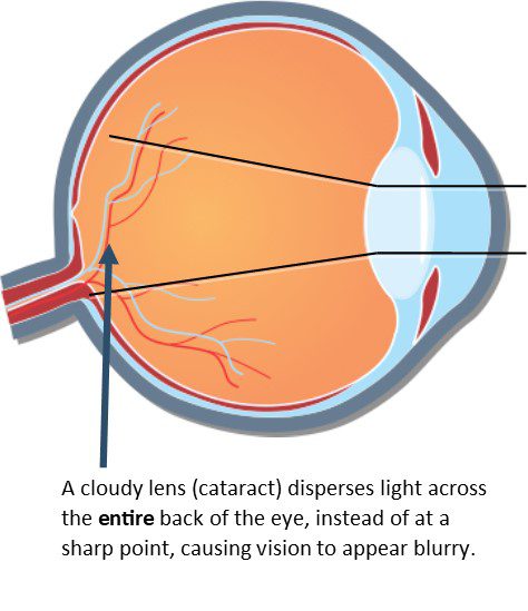 Cataract Diagram #2 Updated