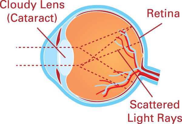 PB Cataract Diagram