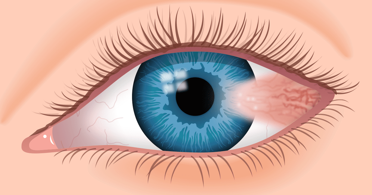 Pterygium