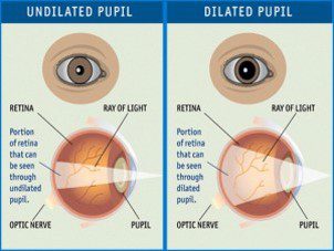 dilation